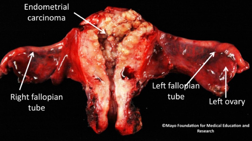 子宮內膜癌 子宮內膜癌