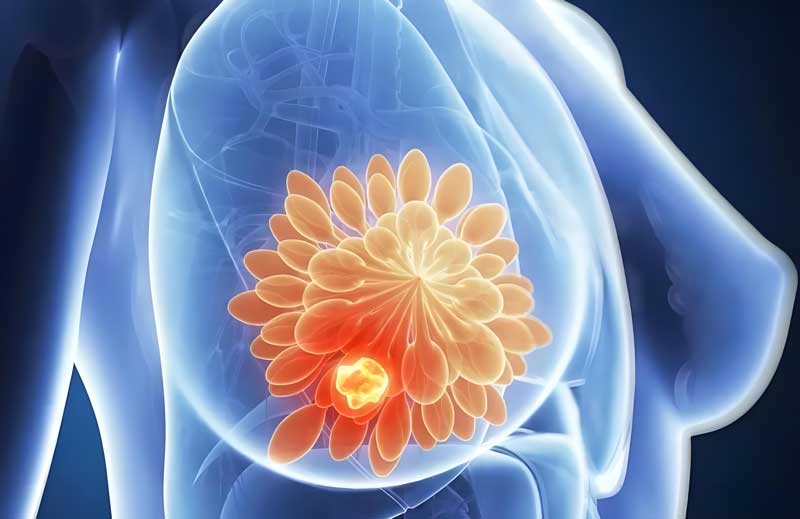 乳癌 乳癌