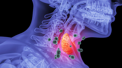 甲狀腺癌 甲狀腺癌