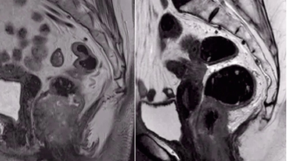 肛門癌（肛門癌）
