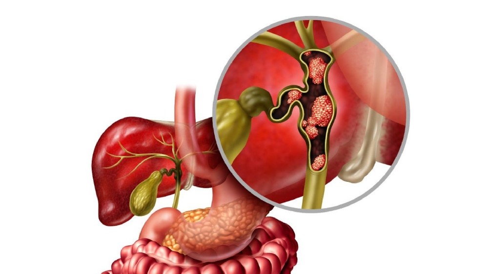 膽管癌（膽管癌）