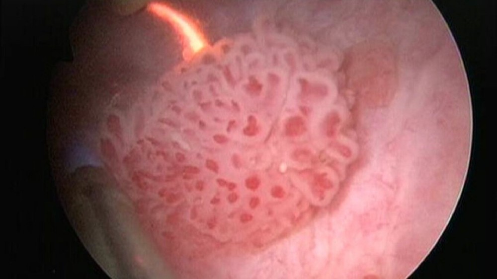 膀胱癌（膀胱上皮癌）