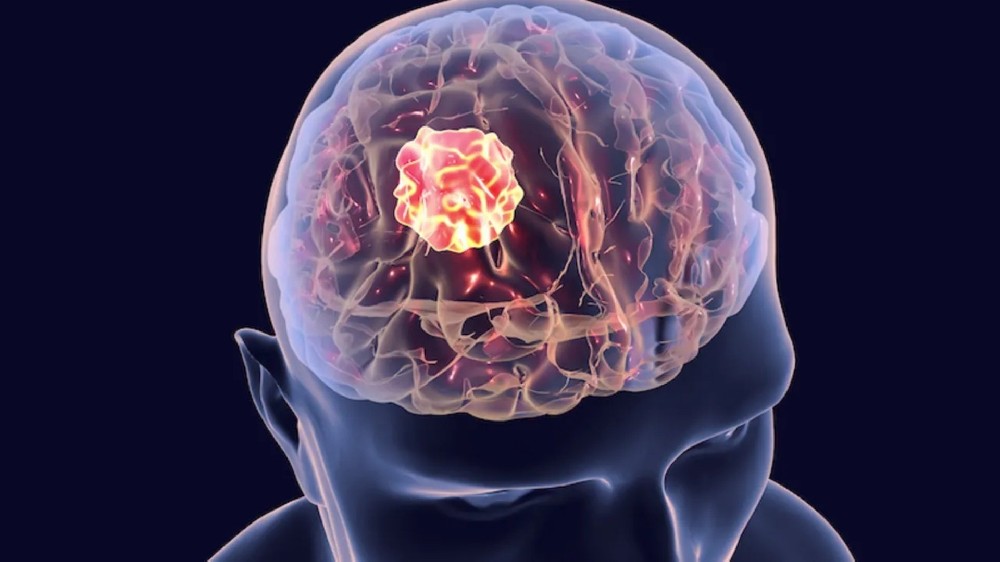 腦癌（惡性腦腫瘤）