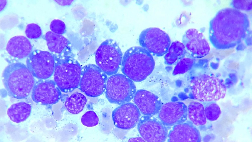 伯基特淋巴瘤（B細胞非霍奇金淋巴瘤）