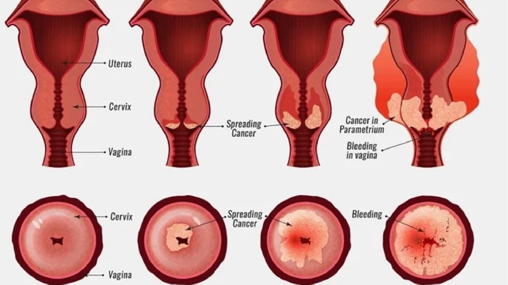 子宮頸癌 (Cervical Carcinoma)
