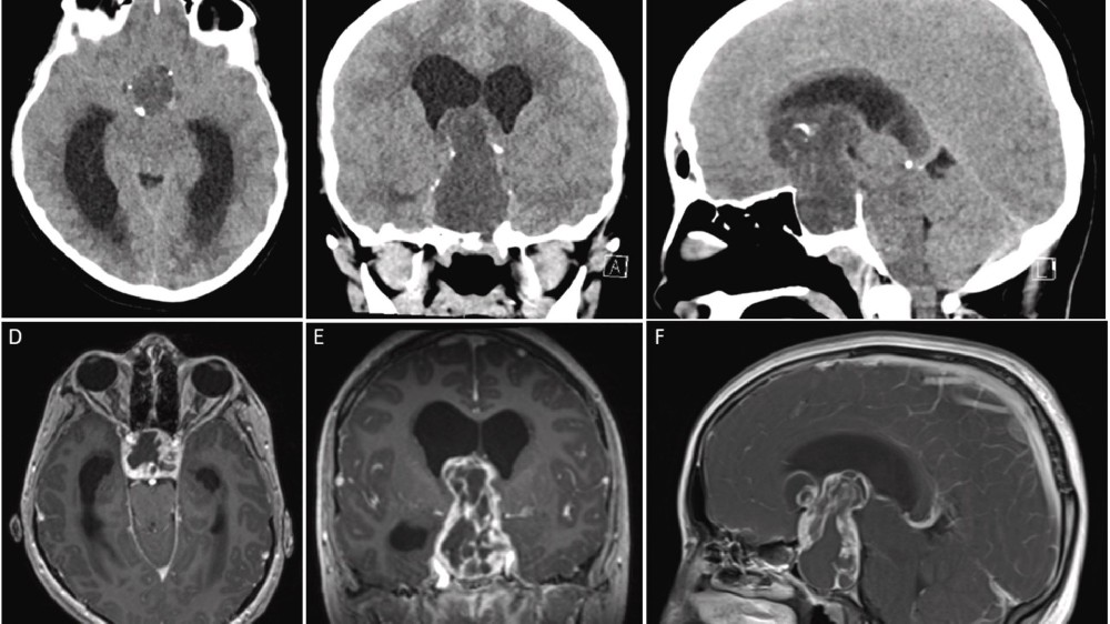 顱咽瘤（良性腦腫瘤）