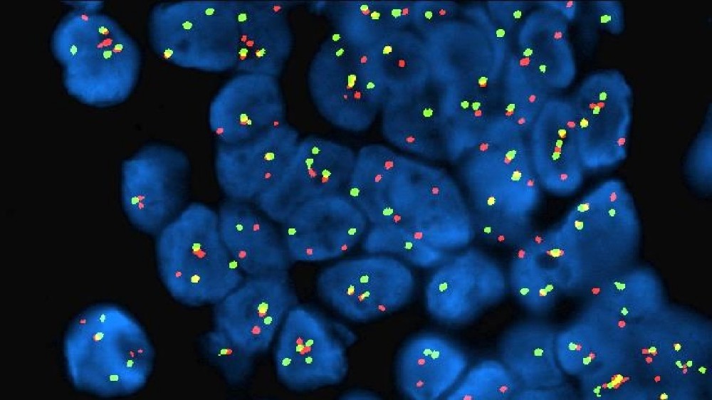 脫屑性小圓細胞瘤 (DSRCT)
