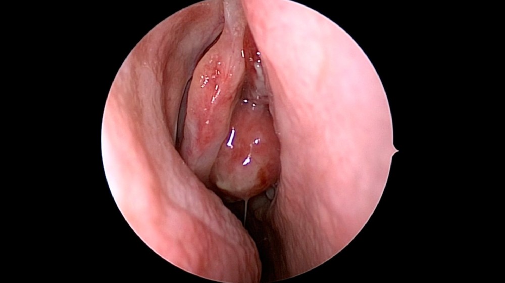 嗅覺神經母細胞瘤 (Esthesioneuroblastoma)