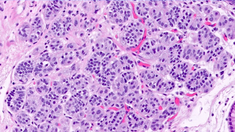 胃腸道神經內分泌腫瘤 (類癌)