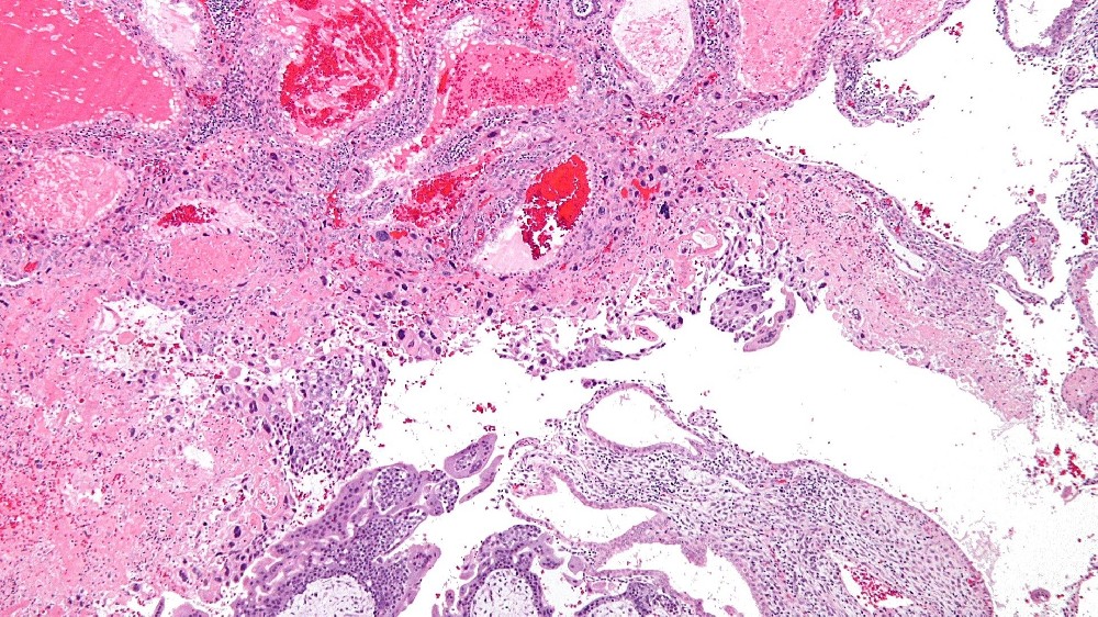 妊娠滋養細胞疾病 GTD