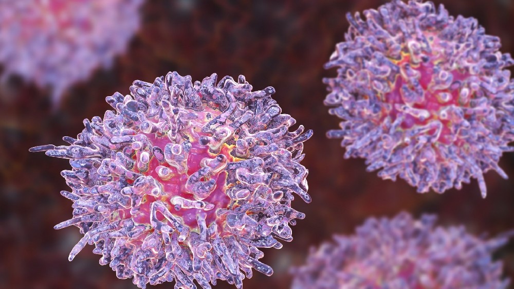 毛細胞白血病 (HCL)