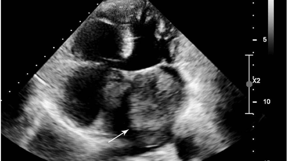 心臟癌（心臟肉瘤）