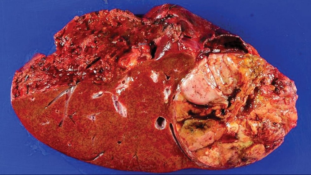 肝細胞癌（肝癌）