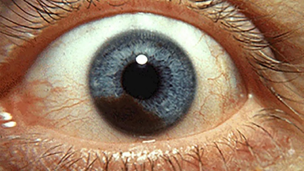 眼內黑色素瘤（葡萄膜黑色素瘤）