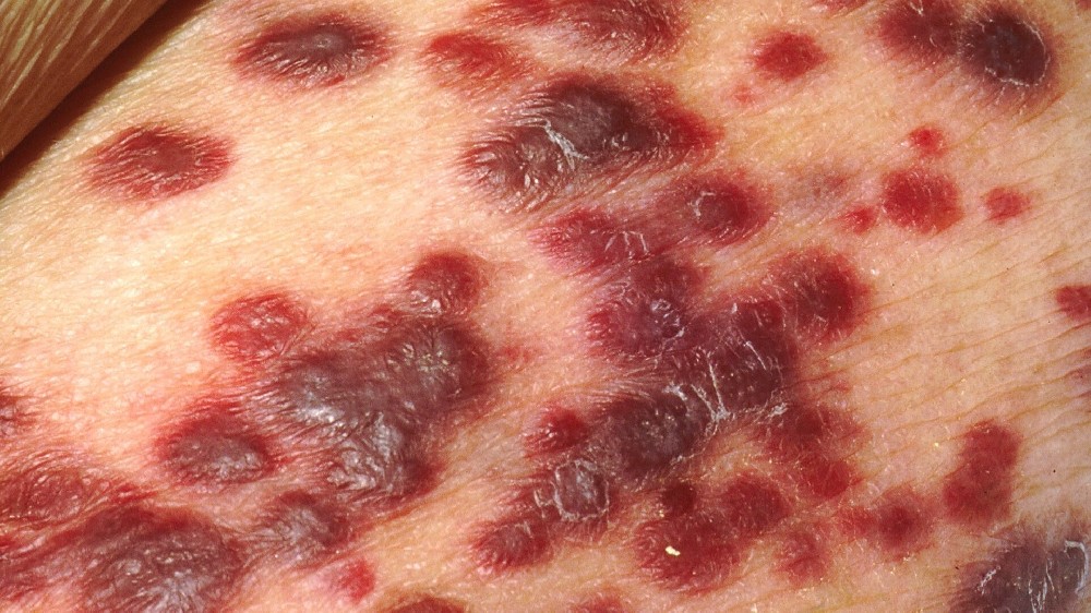 卡波西肉瘤 (KS)