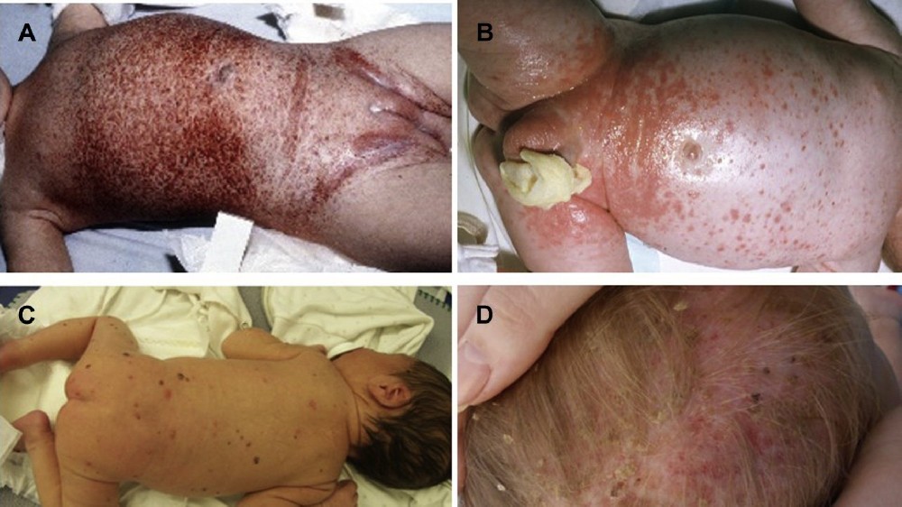 朗格汉斯细胞组织细胞增生症 (LCH)