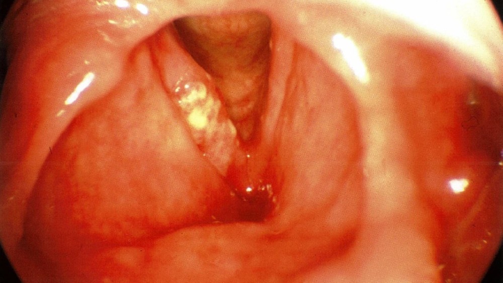 喉癌 (Laryngeal Carcinoma)