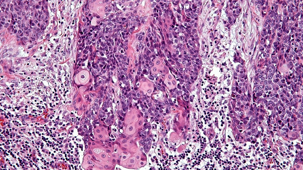 中線縱膈癌 (NUT Carcinoma)