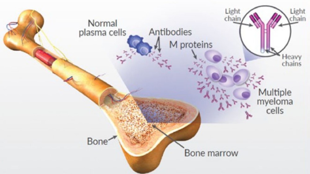 多發性骨髓瘤（血漿細胞骨髓瘤）