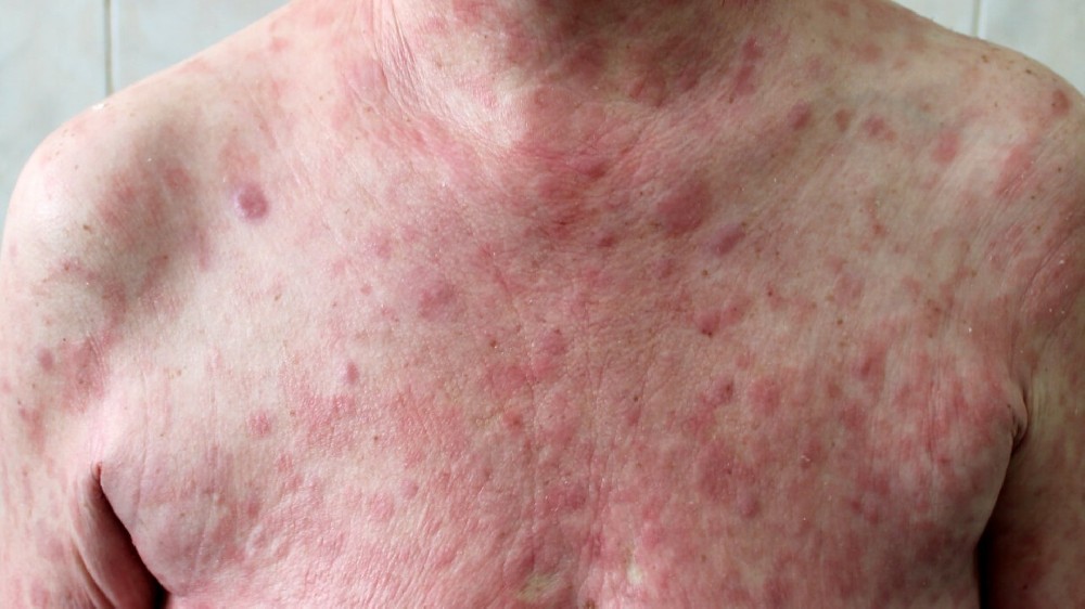 真菌病（皮膚 T 細胞淋巴瘤）