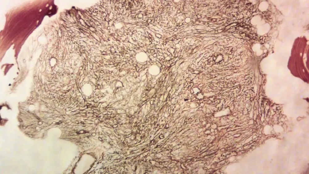 骨髓纖維化（原發性骨髓纖維化）
