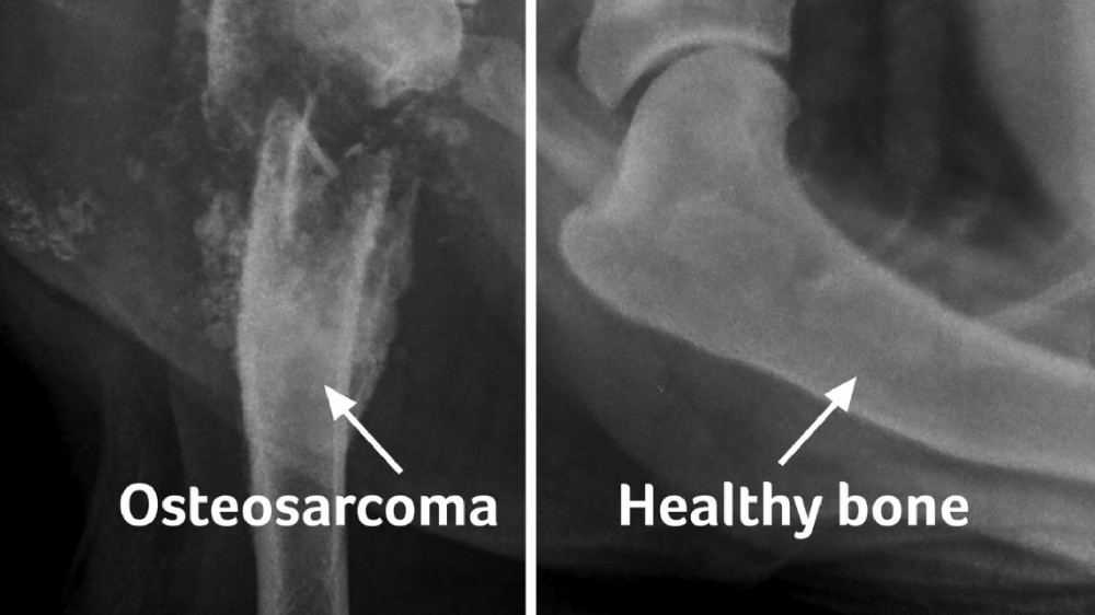 骨肉瘤 (Osteosarcoma)