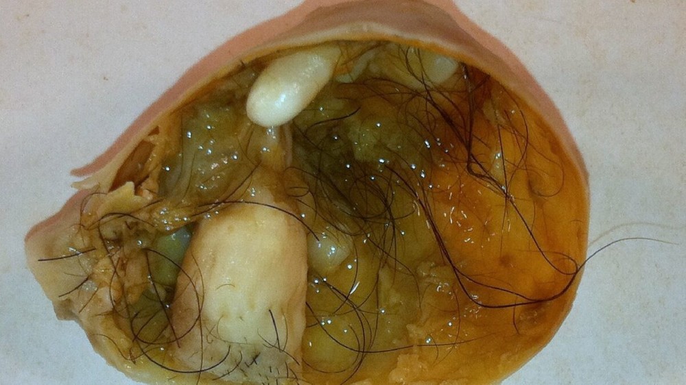 卵巢生殖細胞腫瘤