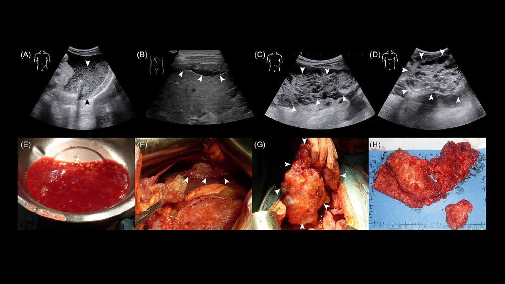假性腹膜肌瘤 (PMP)