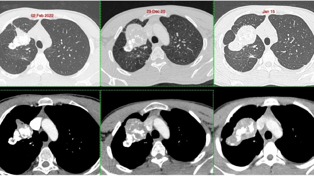 肺發炎性肌纖維母細胞瘤