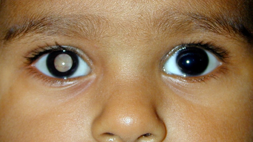 視網膜母細胞瘤（視網膜癌）