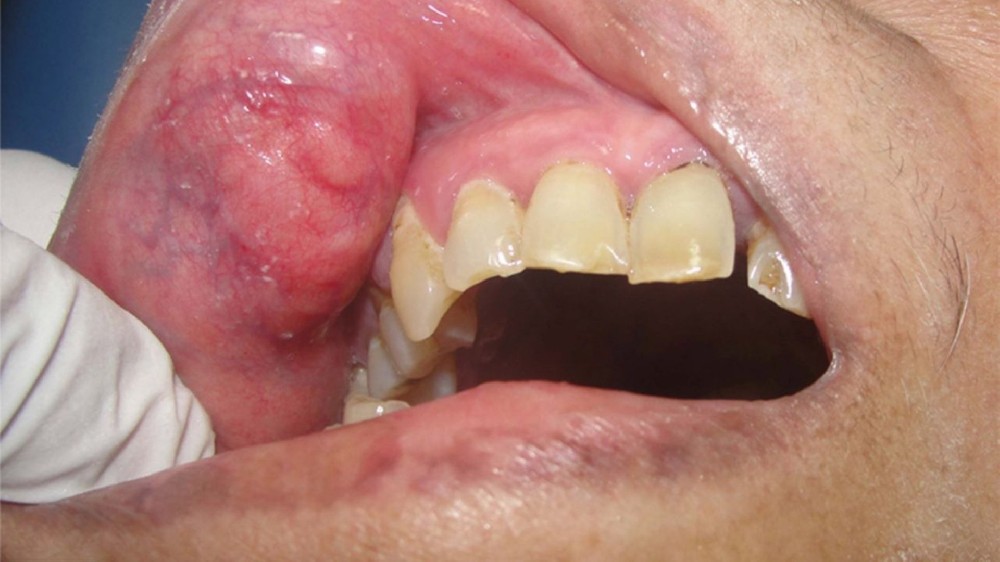 唾液腺癌 (Salivary Gland Carcinoma)