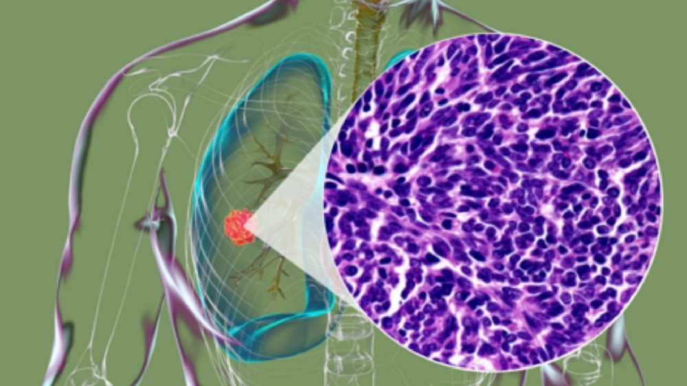 小細胞肺癌 (SCLC)