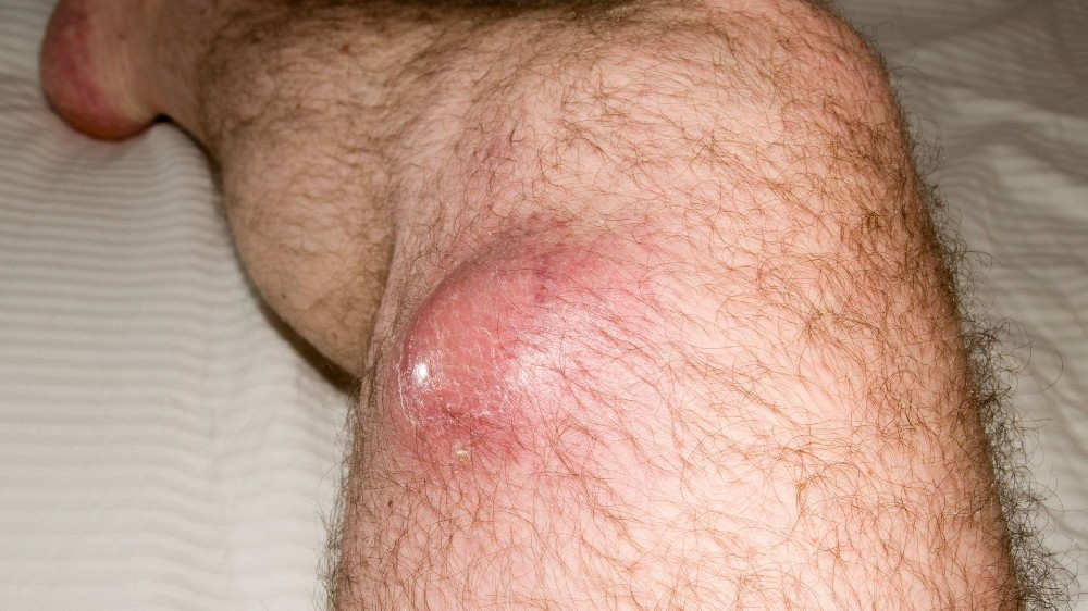 軟組織肉瘤 (STS)