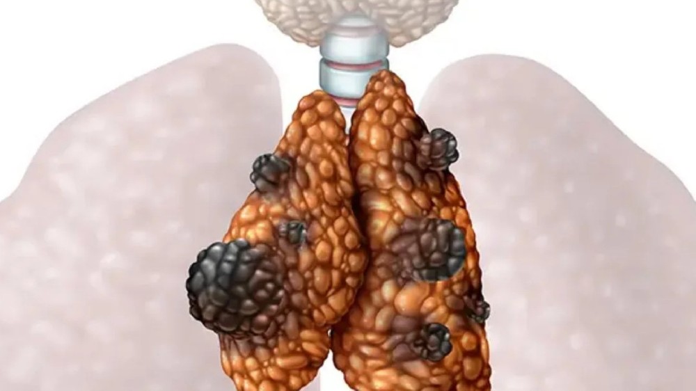 胸腺癌 惡性胸腺腫瘤