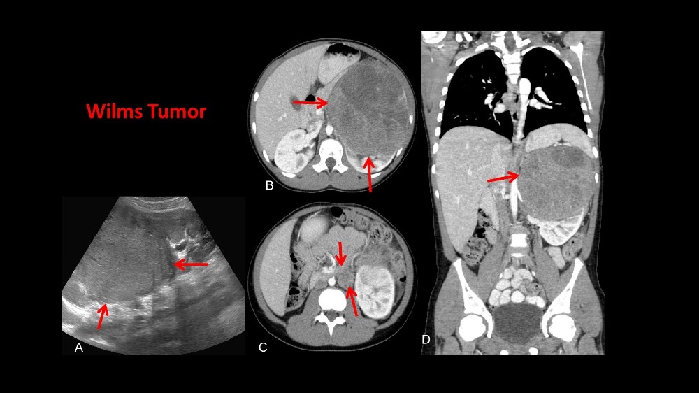 Wilms 腫瘤（腎母細胞瘤）