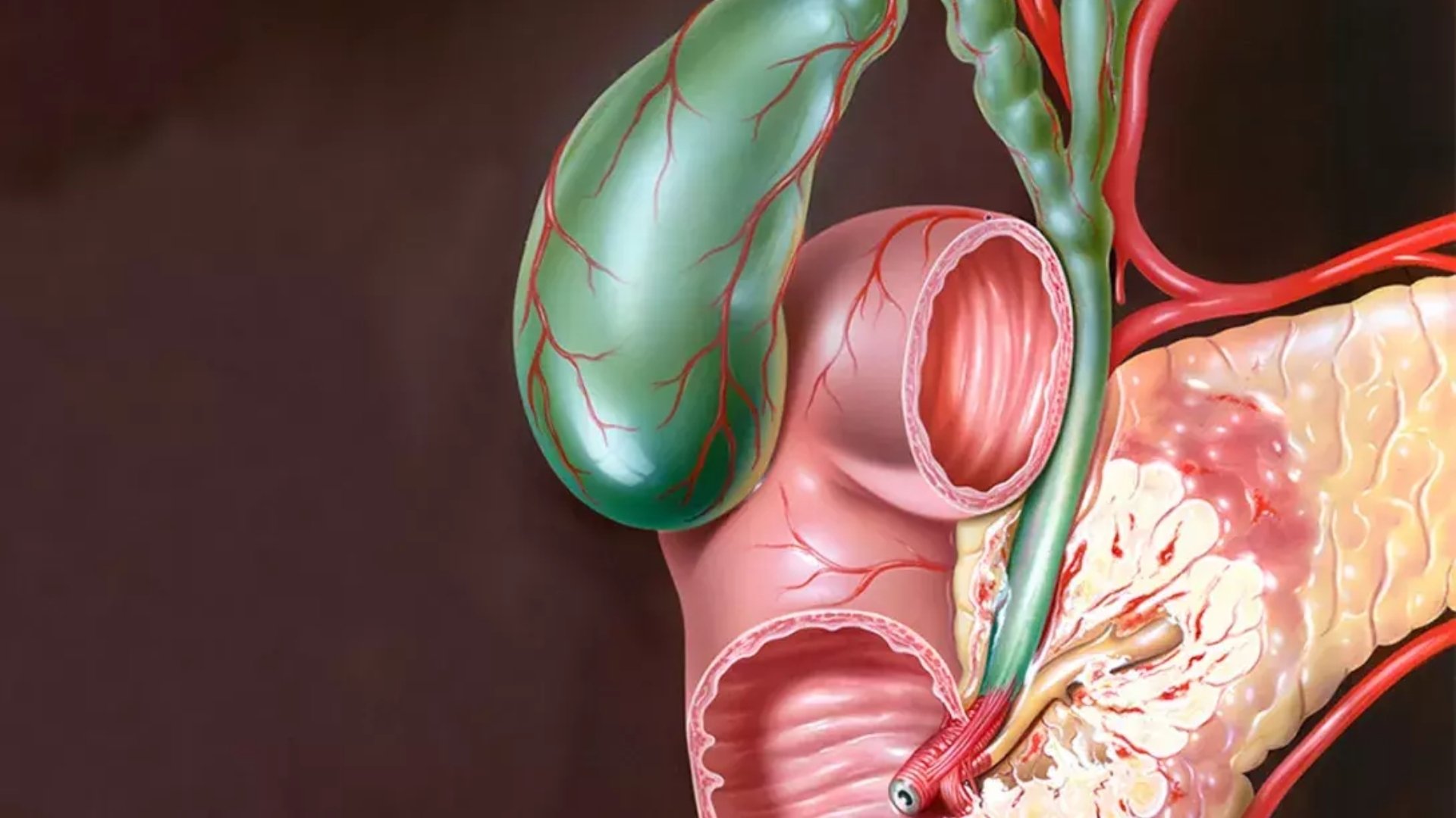 神經內分泌腫瘤 (NET)