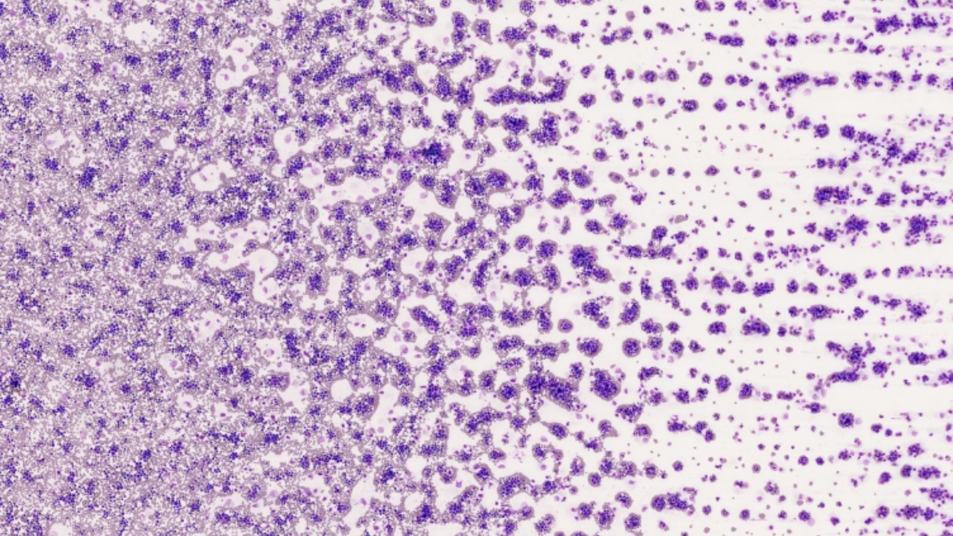 慢性骨髓性白血病 (CML)
