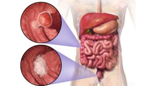 Colorectal cancer illustration
