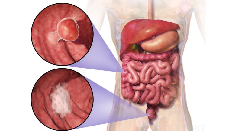 Colorectal cancer illustration