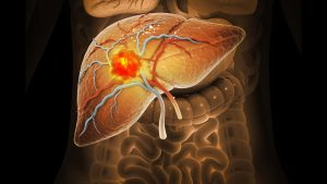 Liver cancer illustration