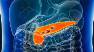 Pancreatic cancer illustration