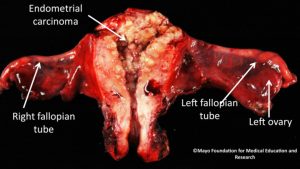 Endometrial cancer illustration