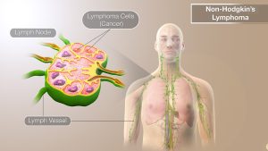 Non-Hodgkin lymphoma illustration