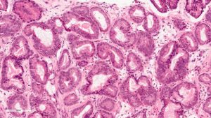 Prostate cancer illustration