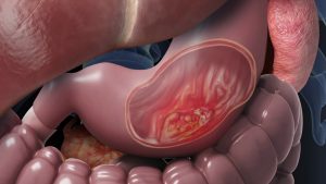 Stomach cancer illustration