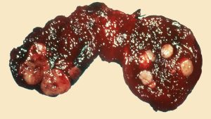 Thyroid cancer illustration