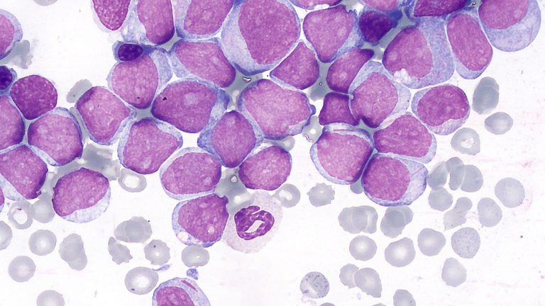 Acute Myeloid Leukemia (AML)