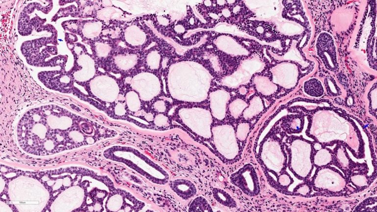 Adenoid Cystic Carcinoma (ACC)
