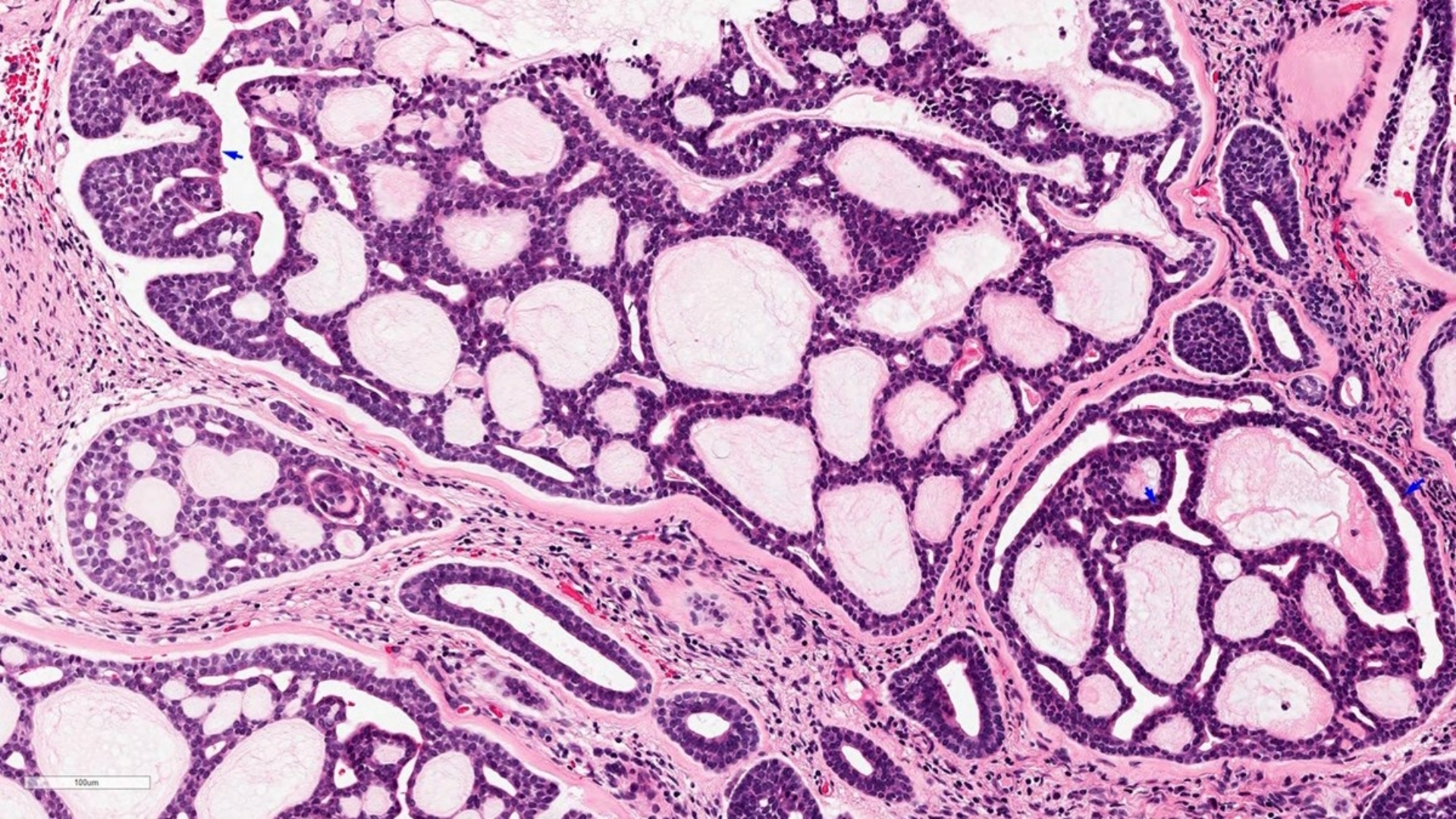 Adenoid Cystic Carcinoma (ACC)