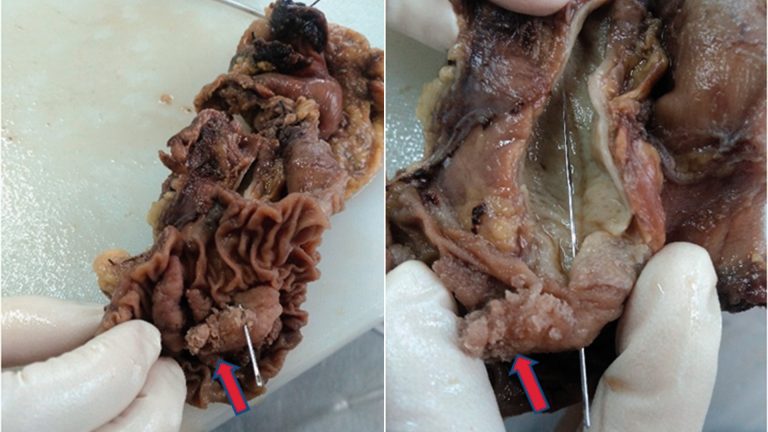 Ampullary Cancer